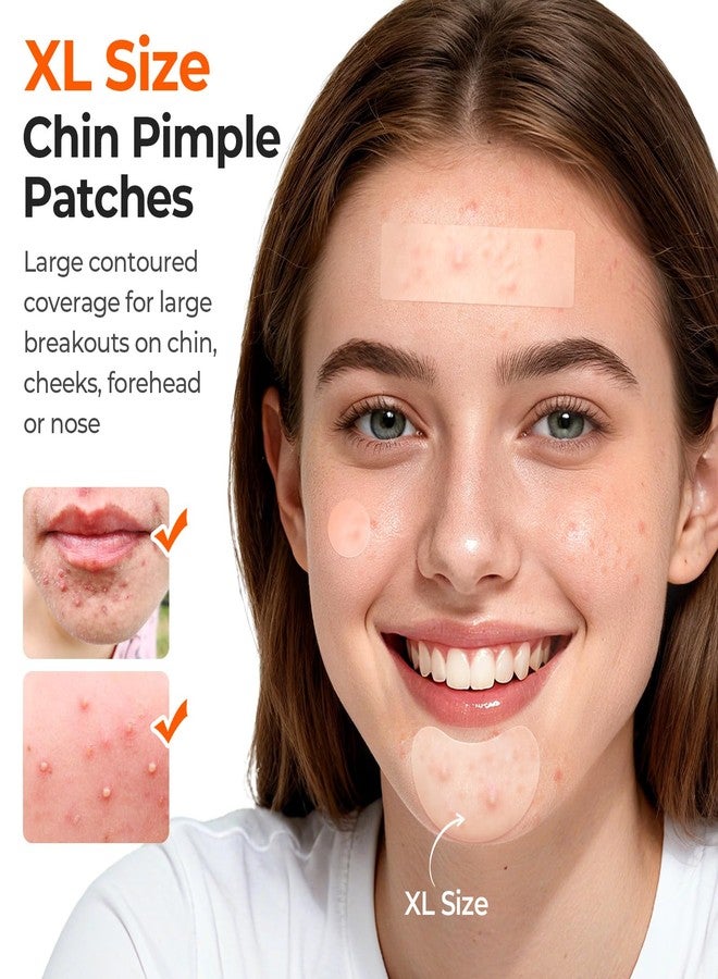 تي كيه تي كيه لصقات هيدروكولويد كبيرة الحجم لعلاج حب الشباب في منطقة الذقن والوجه، لصقة حب الشباب كبيرة الحجم محددة الشكل لمنطقة الفك، شرائط تنظيف المسام للجبهة، ملصقات نقاط لعلاج الشوائب لجميع أنواع البشرة (136 قطعة، 5 أحجام) - Image 3